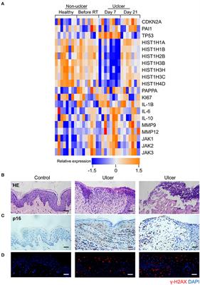 Senolytics (DQ) Mitigates Radiation Ulcers by Removing Senescent Cells